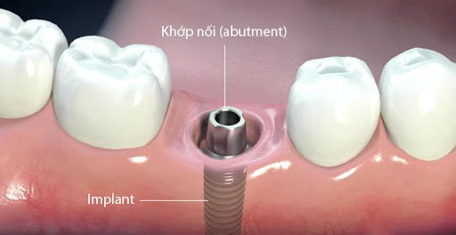 Các Bước Trồng Răng Implant Chuẩn? – Nha Khoa Quốc Tế Á Châu - ảnh 8