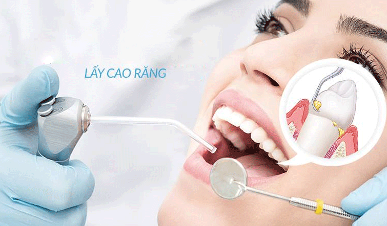 Bao Lâu Lấy Cao Răng 1 Lần? – Nha Khoa Quốc Tế Á Châu - ảnh 9