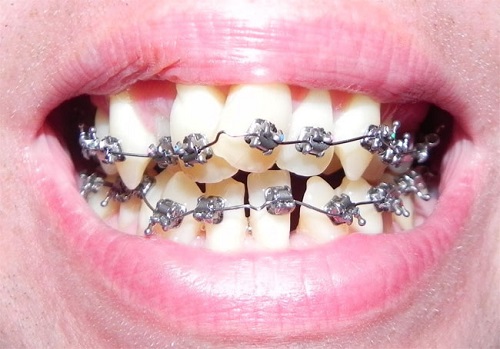 Niềng Răng Hỏng – Dấu Hiệu Nhận Biết Và Cách Khắc Phục - ảnh 1