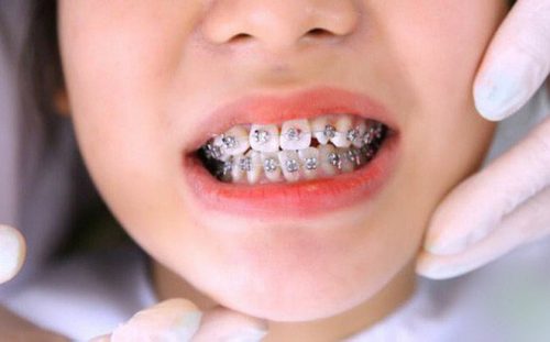 Niềng Răng Hỏng – Dấu Hiệu Nhận Biết Và Cách Khắc Phục - ảnh 3