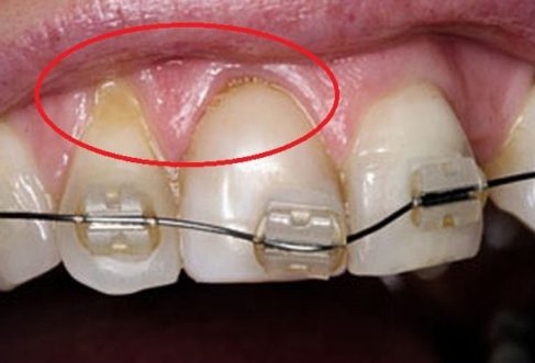 Niềng Răng Hỏng – Dấu Hiệu Nhận Biết Và Cách Khắc Phục - ảnh 5