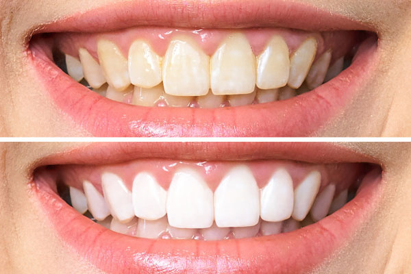 Tẩy trắng răng duy trì bao lâu? - ảnh 2