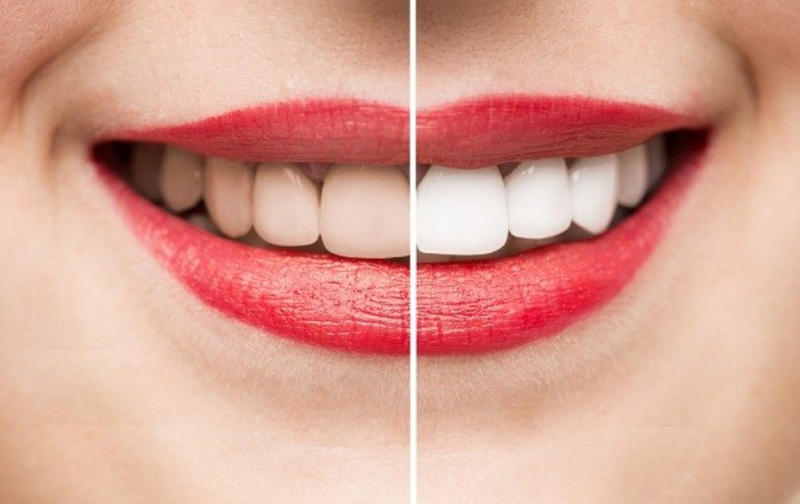 Tẩy trắng răng duy trì bao lâu? - ảnh 3