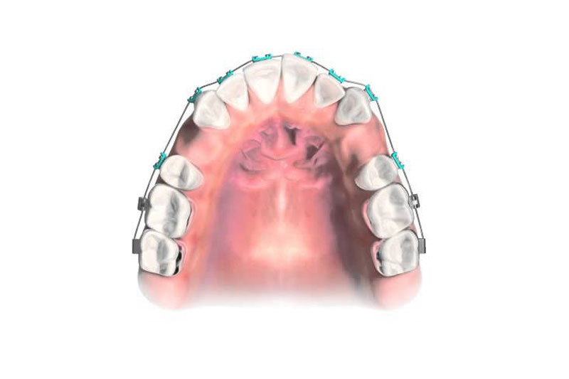 Niềng răng nhổ 4 hay 8 cái răng? – Nha Khoa Quốc Tế Á Châu - ảnh 2