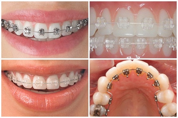 Niềng răng nhổ 4 hay 8 cái răng? – Nha Khoa Quốc Tế Á Châu - ảnh 5