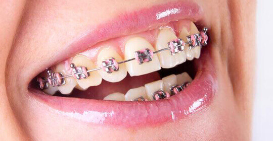 Niềng Răng Hô Có Phải Nhổ Răng Không? – Nha Khoa Quốc Tế Á Châu - ảnh 6