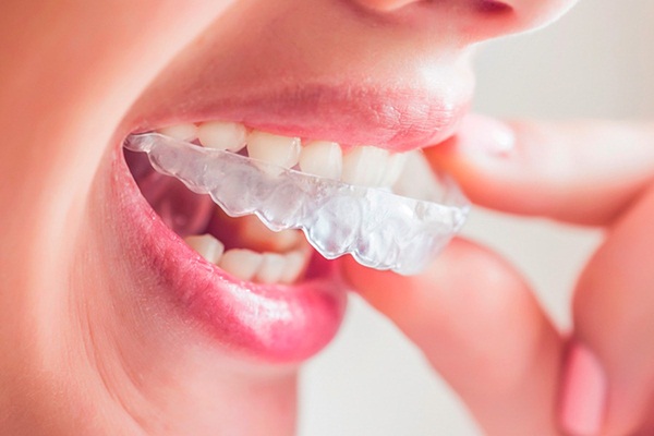 Niềng Răng Hô Có Phải Nhổ Răng Không? – Nha Khoa Quốc Tế Á Châu - ảnh 8