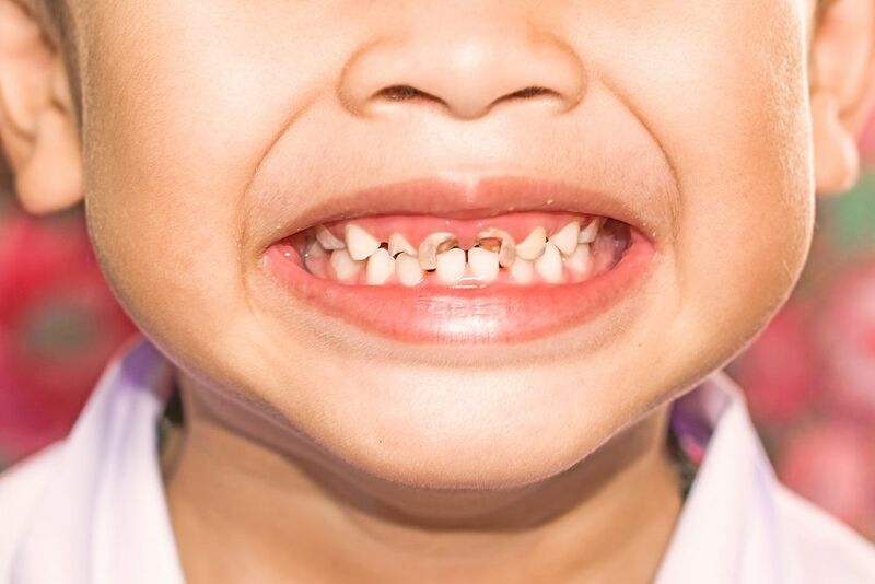 Trẻ Bị Sâu Răng: Nguyên Nhân, Dấu Hiệu Và Cách Điều Trị Hiệu Quả - ảnh 7