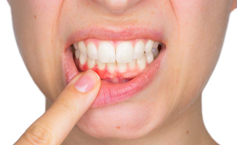 Chảy Máu Chân Răng Là Bệnh Gì? Nguyên Nhân Và Cách Điều Trị Hiệu Quả - ảnh 4