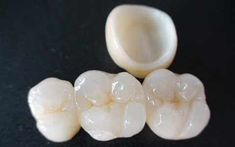 Trồng Răng Implant Trọn Gói Bao Nhiêu Tiền? – Nha Khoa Quốc Tế Á Châu - ảnh 5