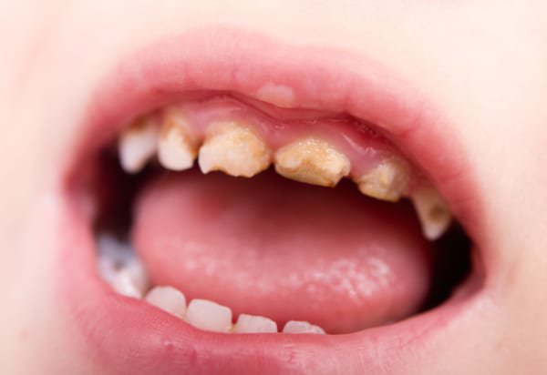 Trẻ Bị Sâu Răng: Nguyên Nhân, Dấu Hiệu Và Cách Điều Trị Hiệu Quả - ảnh 3