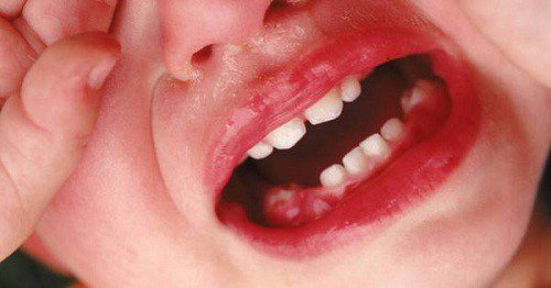Trẻ Bị Sâu Răng: Nguyên Nhân, Dấu Hiệu Và Cách Điều Trị Hiệu Quả - ảnh 4