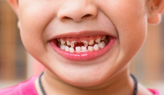 Trẻ Bị Sâu Răng: Nguyên Nhân, Dấu Hiệu Và Cách Điều Trị Hiệu Quả - ảnh 1