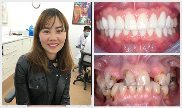 Trồng Răng Implant Trọn Gói Bao Nhiêu Tiền? – Nha Khoa Quốc Tế Á Châu - ảnh 7