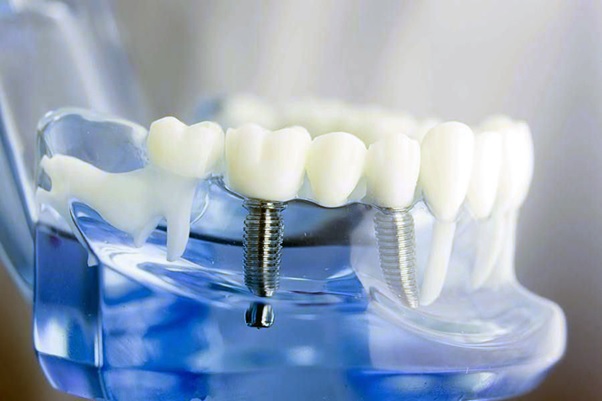 Trồng Răng Implant Trọn Gói Bao Nhiêu Tiền? – Nha Khoa Quốc Tế Á Châu - ảnh 2
