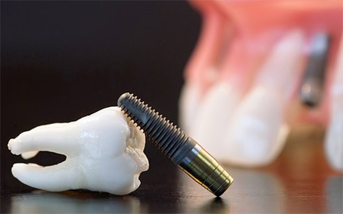 Trồng Răng Implant Trọn Gói Bao Nhiêu Tiền? – Nha Khoa Quốc Tế Á Châu - ảnh 6