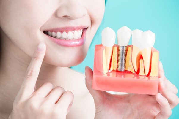 Trồng Răng Implant Trọn Gói Bao Nhiêu Tiền? – Nha Khoa Quốc Tế Á Châu - ảnh 1