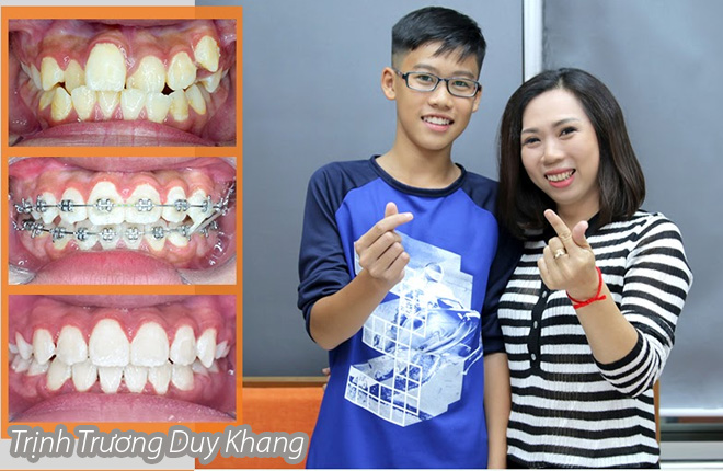 Niềng Răng Khiến Răng Di Chuyển Như Nào? – Nha Khoa Quốc Tế Á Châu - ảnh 11