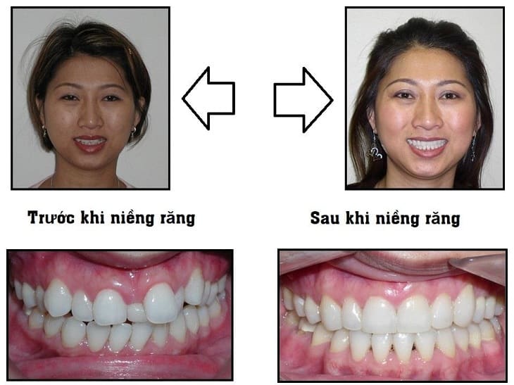 Niềng Răng Khiến Răng Di Chuyển Như Nào? – Nha Khoa Quốc Tế Á Châu - ảnh 10