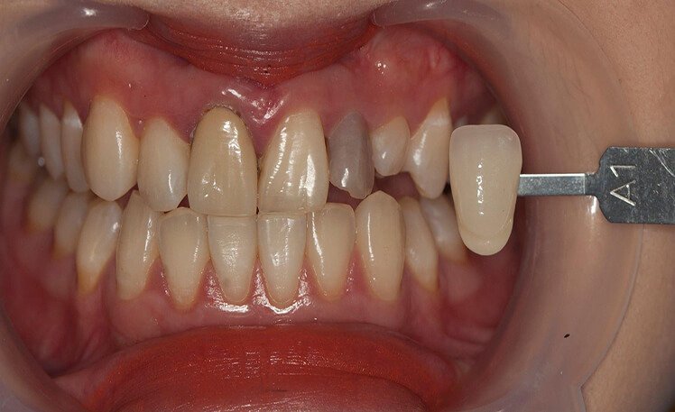 Trường Hợp Nào Nên Bọc Răng Sứ? – Nha Khoa Quốc Tế Á Châu - ảnh 6
