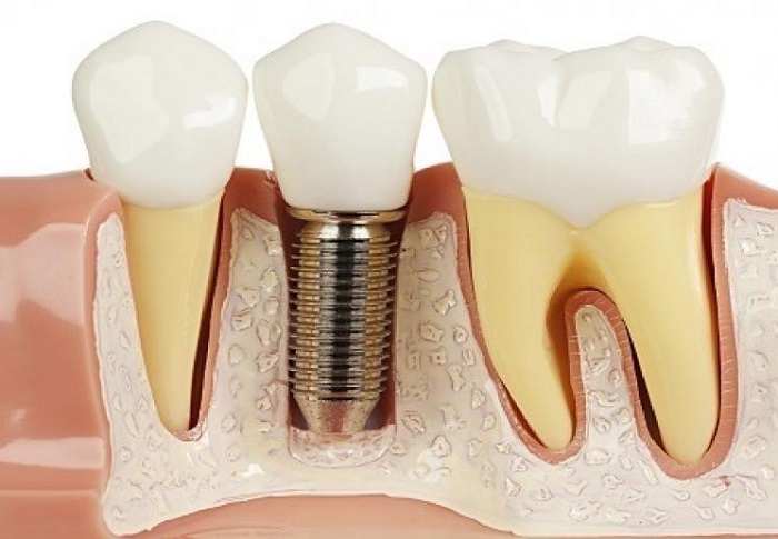 Review Trồng Răng Implant Thực Tế Từ Khách Hàng [Mới Nhất] - ảnh 3