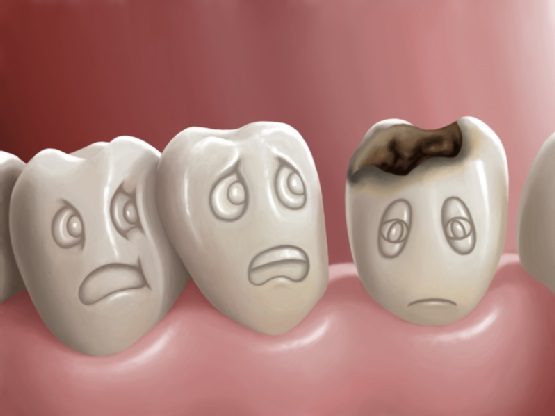 Bệnh Sâu Răng: Nguyên Nhân, Triệu Chứng Và Cách Điều Trị Hiệu Quả - ảnh 3