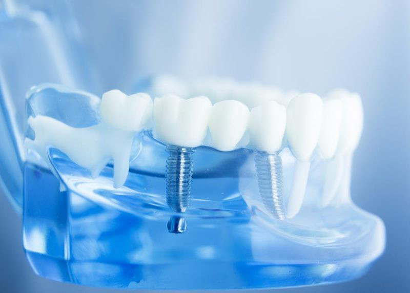 Review Trồng Răng Implant Thực Tế Từ Khách Hàng [Mới Nhất] - ảnh 1