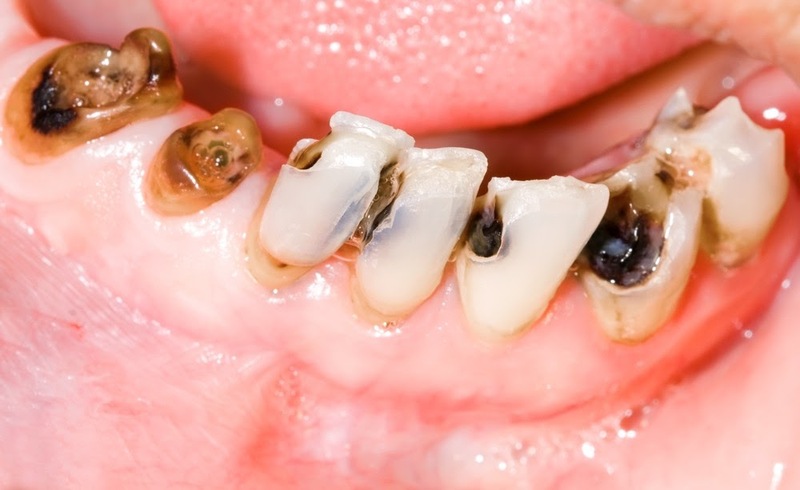 Bệnh Sâu Răng: Nguyên Nhân, Triệu Chứng Và Cách Điều Trị Hiệu Quả - ảnh 2