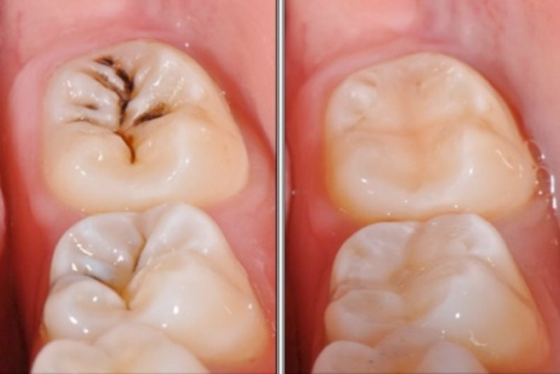 Răng Sâu Có Lỗ Thủng Phải Làm Sao? – Nha Khoa Quốc Tế Á Châu - ảnh 7