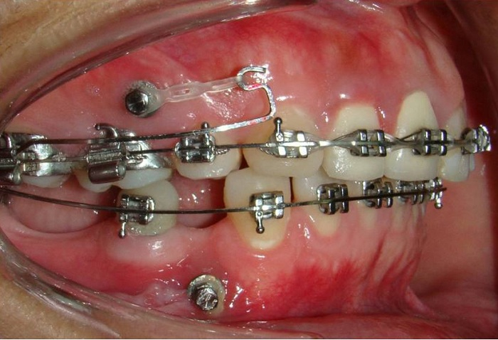 Bị Mất Răng Có Niềng Răng Được Không? – Nha Khoa Quốc Tế Á Châu - ảnh 1