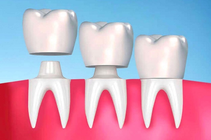 Cảm Giác Khi Bọc Răng Sứ Như Thế Nào? – Nha Khoa Quốc Tế Á Châu - ảnh 1