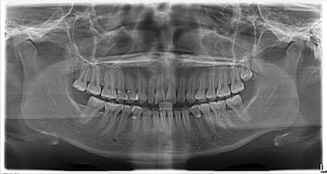 Lý Do Cần Chụp X-Quang Trước Khi Niềng Răng? – Nha Khoa Quốc Tế Á Châu - ảnh 4
