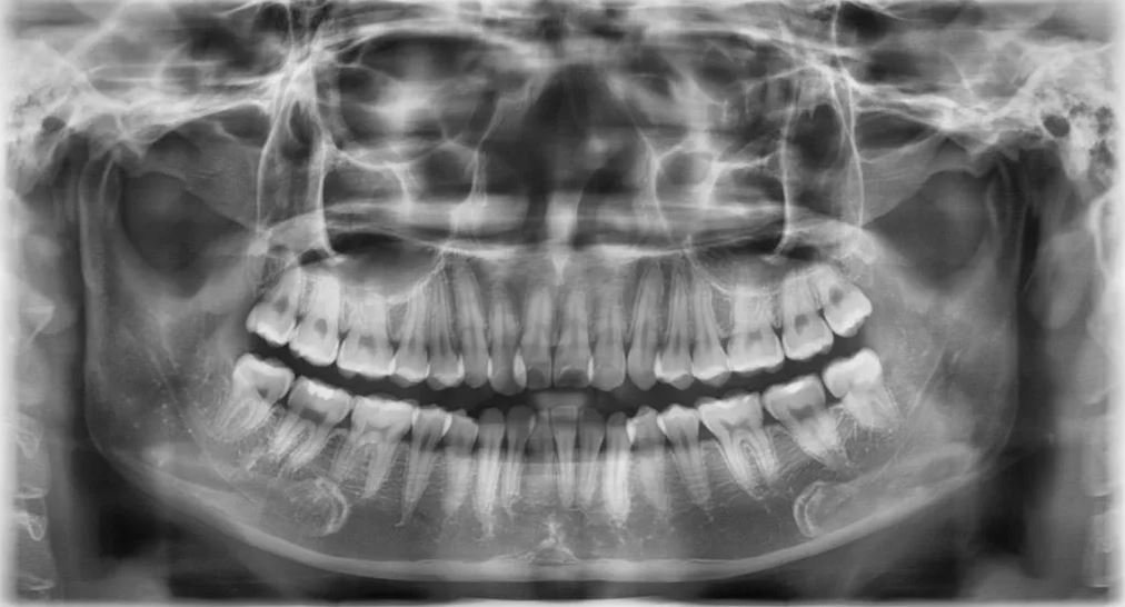 Lý Do Cần Chụp X-Quang Răng Trước Khi Niềng Răng? – Nha Khoa Quốc Tế Á Châu - ảnh 1