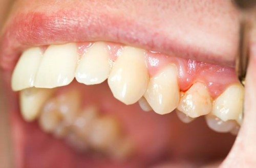 Đau Nhức Răng Khi Nhai Phải Làm Sao? – Nha Khoa Quốc Tế Á Châu - ảnh 3