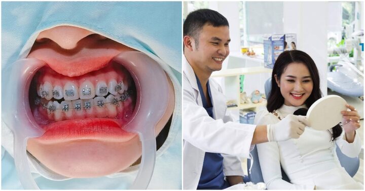 Bong Mắc Cài Niềng Răng Phải Làm Sao? – Nha Khoa Quốc Tế Á Châu - ảnh 8
