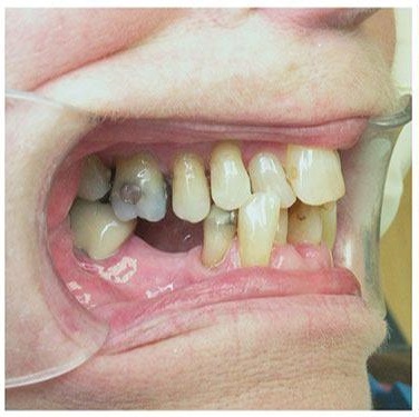Bị Mất Răng Có Niềng Răng Được Không? – Nha Khoa Quốc Tế Á Châu - ảnh 3