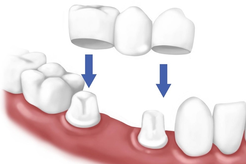Bị Mất Răng Có Niềng Răng Được Không? – Nha Khoa Quốc Tế Á Châu - ảnh 7
