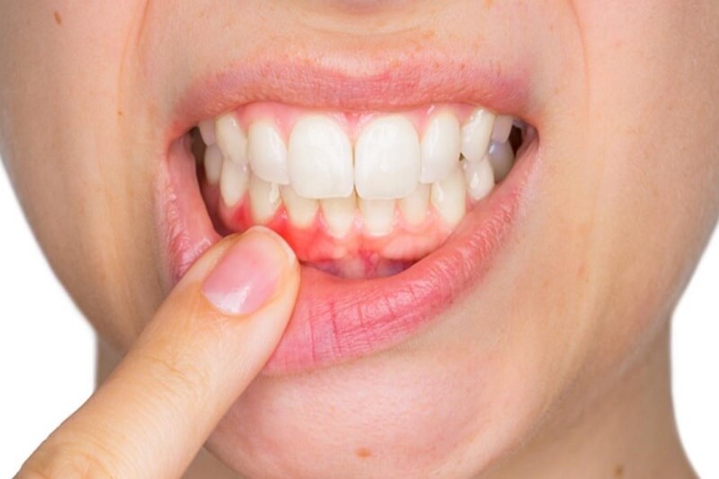 Cảm Giác Khi Bọc Răng Sứ Như Thế Nào? – Nha Khoa Quốc Tế Á Châu - ảnh 4