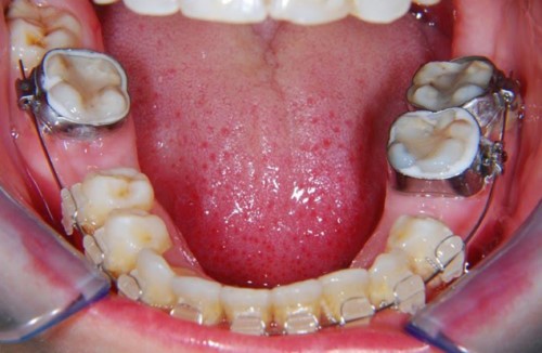 Bị Mất Răng Có Niềng Răng Được Không? – Nha Khoa Quốc Tế Á Châu - ảnh 4