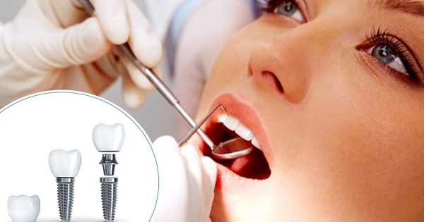 Trồng Răng Implant Bao Lâu Thì Xong? – Nha Khoa Quốc Tế Á Châu - ảnh 1