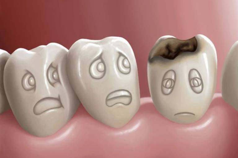 Bị Sâu Răng Có Niềng Răng Được Không? Nha Khoa Quốc Tế Á Châu - ảnh 1