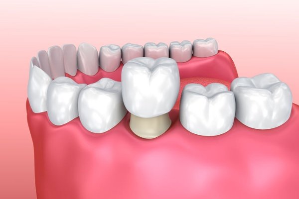Răng Đã Lấy Tủy Có Niềng Răng Được Không? - Bác Sĩ Giải Đáp - ảnh 5