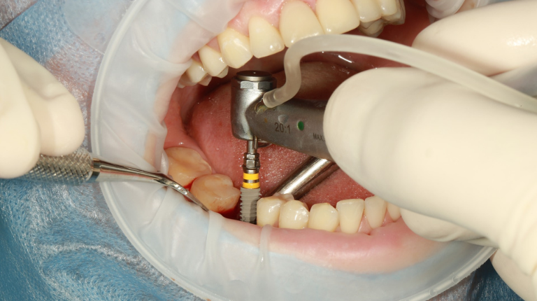 Cấy Răng Implant Tức Thì: Ưu Điểm, Điều Kiện & Quy Trình Thực Hiện - ảnh 3