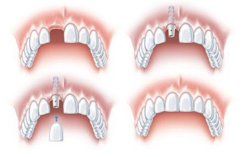 Cấy Răng Implant Tức Thì: Ưu Điểm, Điều Kiện & Quy Trình Thực Hiện - ảnh 5