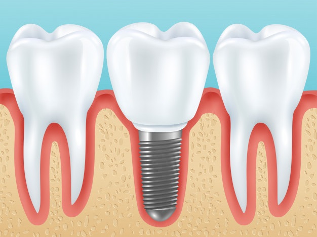 Cấy Răng Implant Tức Thì: Ưu Điểm, Điều Kiện & Quy Trình Thực Hiện - ảnh 1