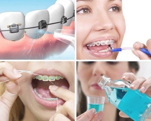 Bị Sâu Răng Có Niềng Răng Được Không? Nha Khoa Quốc Tế Á Châu - ảnh 8