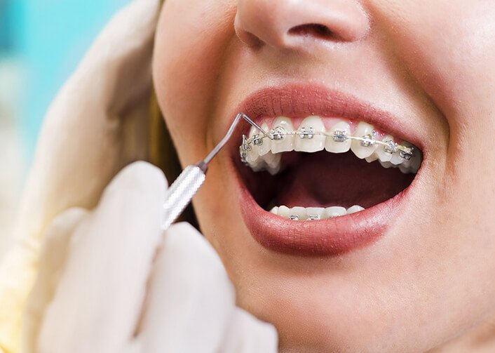 Bị Sâu Răng Có Niềng Răng Được Không? Nha Khoa Quốc Tế Á Châu - ảnh 3