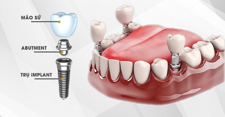 Làm Răng Implant Bao Lâu Thì Hỏng? – Nha Khoa Quốc Tế Á Châu - ảnh 2