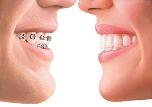 Bị Sâu Răng Có Niềng Răng Được Không? Nha Khoa Quốc Tế Á Châu - ảnh 7