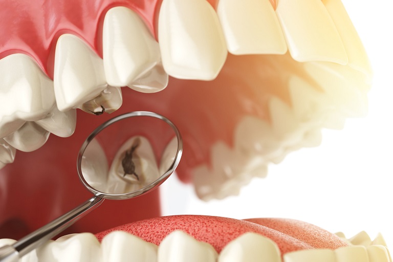 Bị Sâu Răng Có Niềng Răng Được Không? Nha Khoa Quốc Tế Á Châu - ảnh 2